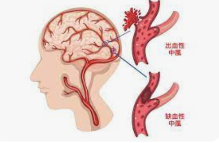 如何快速治疗防治脑中风