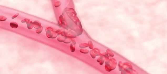 权威解析｜新冠死亡与大白肺