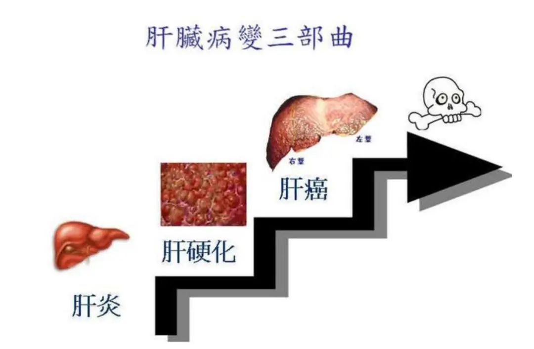 疑难杂症 | 肝胆疾病：六年免疫类GGT谷氨酰基转移酶增高类疾病