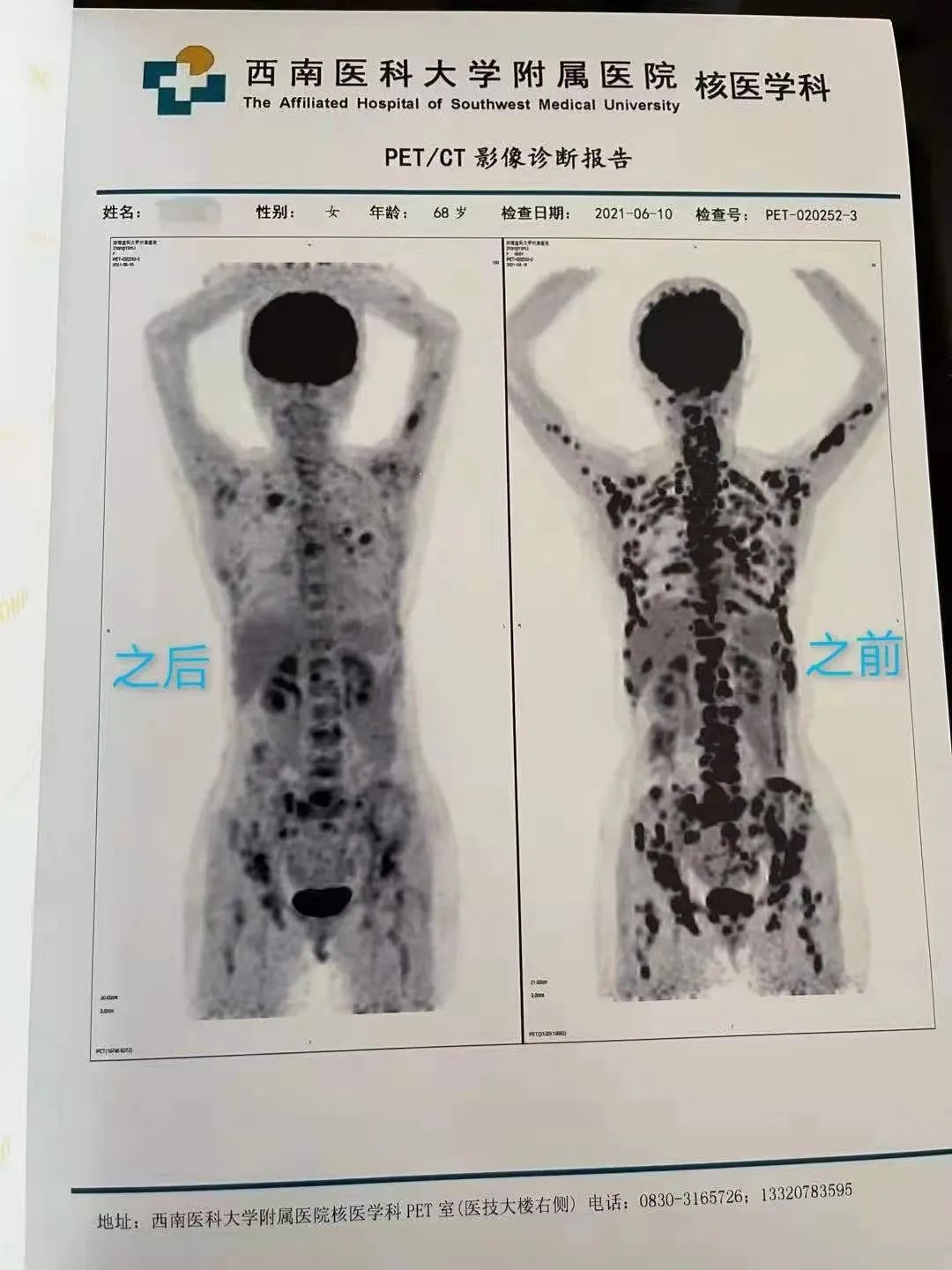 真实案例| 妈妈的抗癌日记（一）