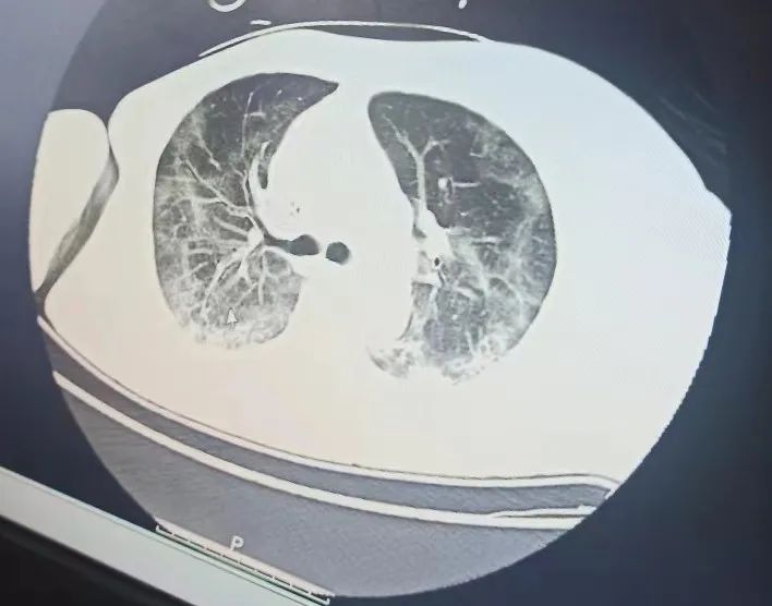 ICU生死一线 | 母亲大白肺70%，中药一个月奇迹般地康复了，复查时肺与常人无异