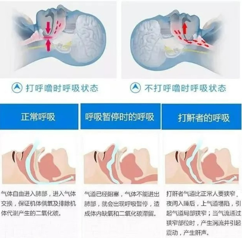 打呼.jpg